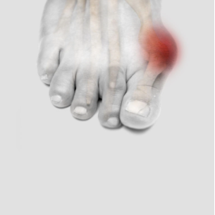 Bunions treatment in St Catharines and Niagara Region