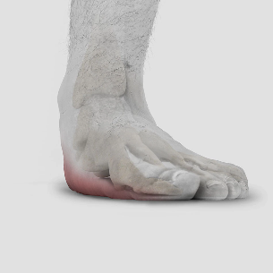 Flat Feet treatment in St Catharines and Niagara Region