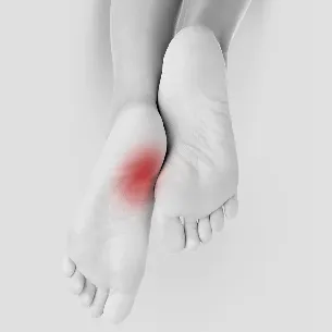 Plantar Fasciitis treatment in St Catharines and Niagara Region