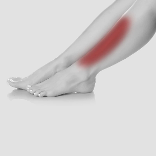 Shin Splints treatment in St Catharines and Niagara Region